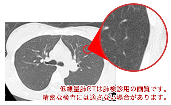 CTの写真 低線量肺CTは肺検診用の画質です。 精密な検査には適さない場合があります。